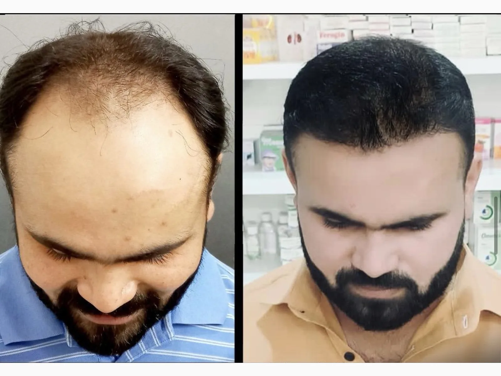 Hair transplant result, case 1 — before and after